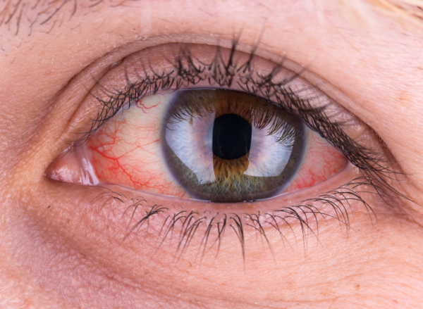 Emergency Eyecare now available at ALL Mackey Opticians practices